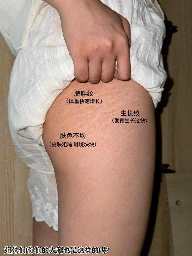 妊娠紋的開題報告,探索畢業季與妊娠紋的故事 第1張 妊娠紋的開題報告,探索畢業季與妊娠紋的故事 第1張